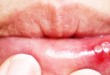 آفت دهان و روش های درمان سنتی-درست مصرف کنیم - آموزش همگانی - آگاهی مصرف